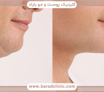 لیفت غیر جراحی گردن