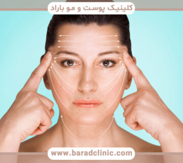 همه چیز درباره جراحی لیفت شقیقه