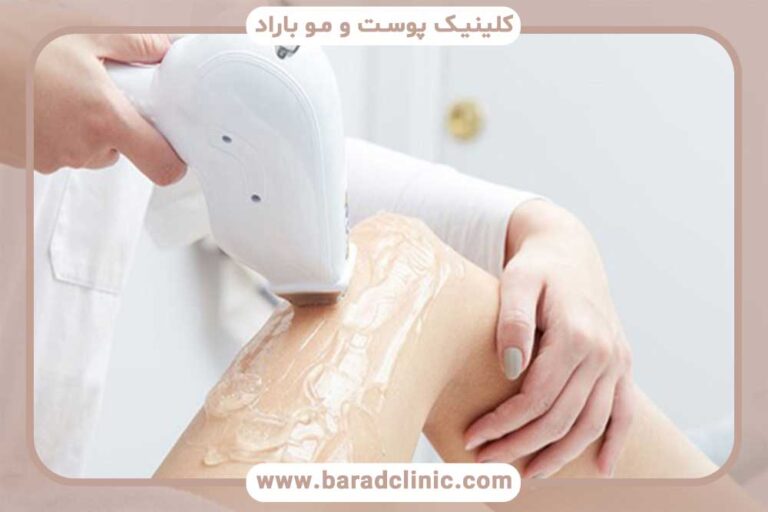 Laser hair removal
