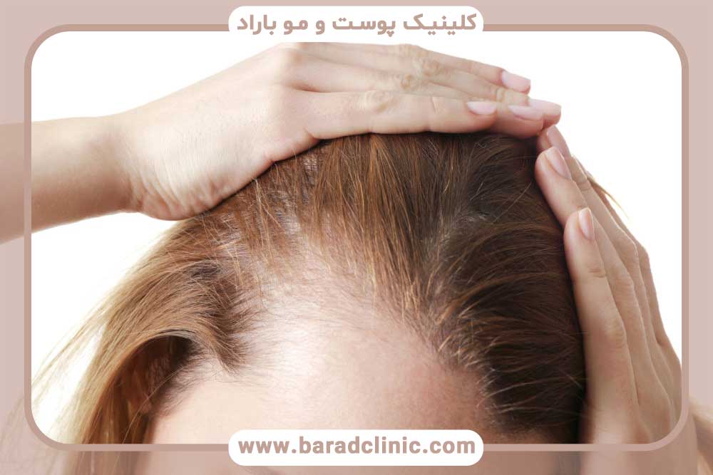 Hair transplant in women