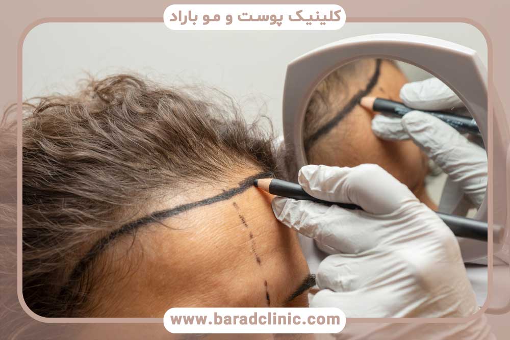 Hair transplant procedures