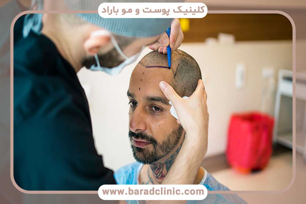 Hair and eyebrow transplantation: How to choose the best center?
