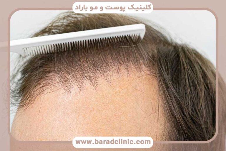 Re-implantation of hair
