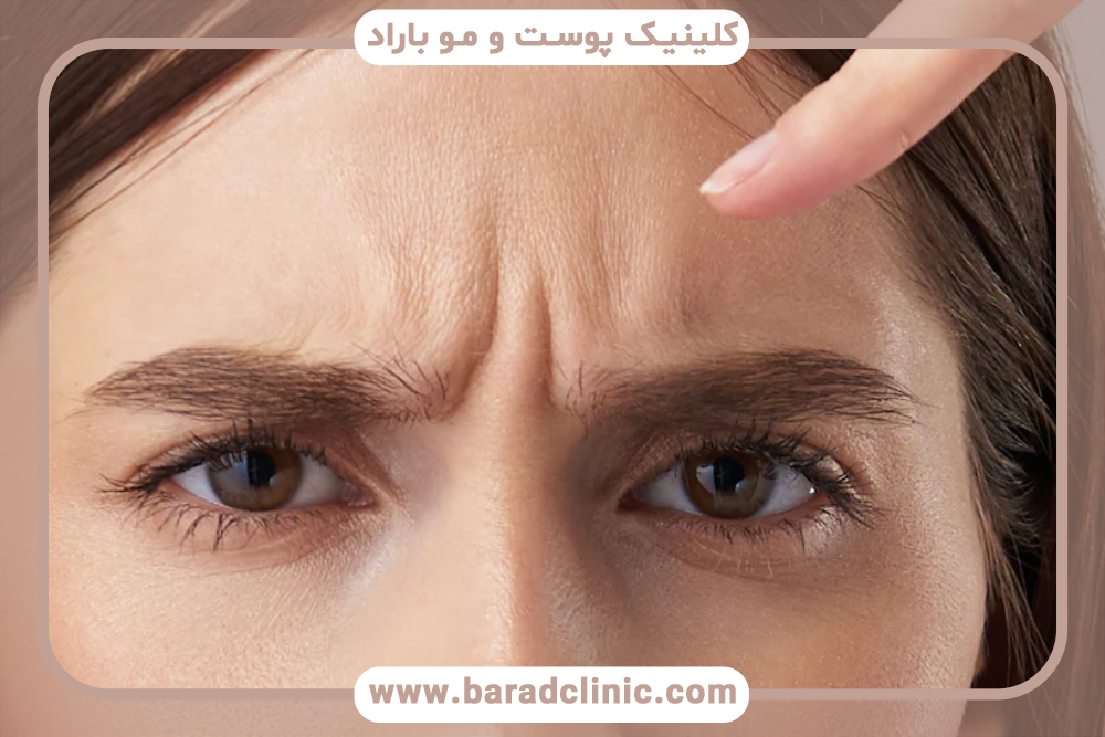 تأثیر تزریق بوتاکس بر خطوط اخم بین دو ابرو