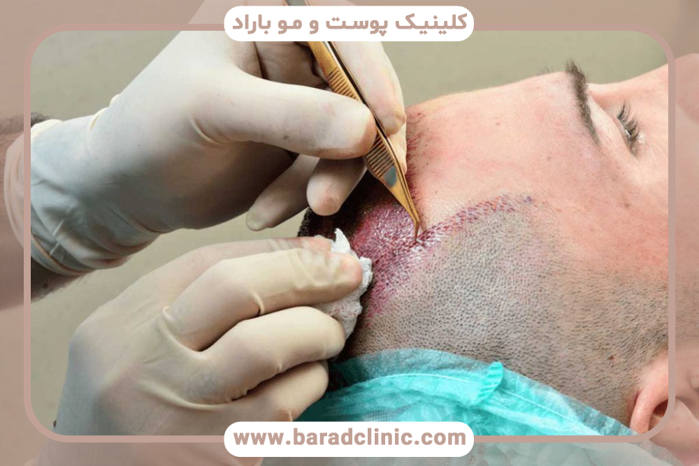 مراحل کاشت مو به روش SUT چیست؟