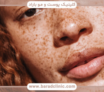 بیماری پیسی یا لک و پیس چیست و چگونه درمان میشود؟