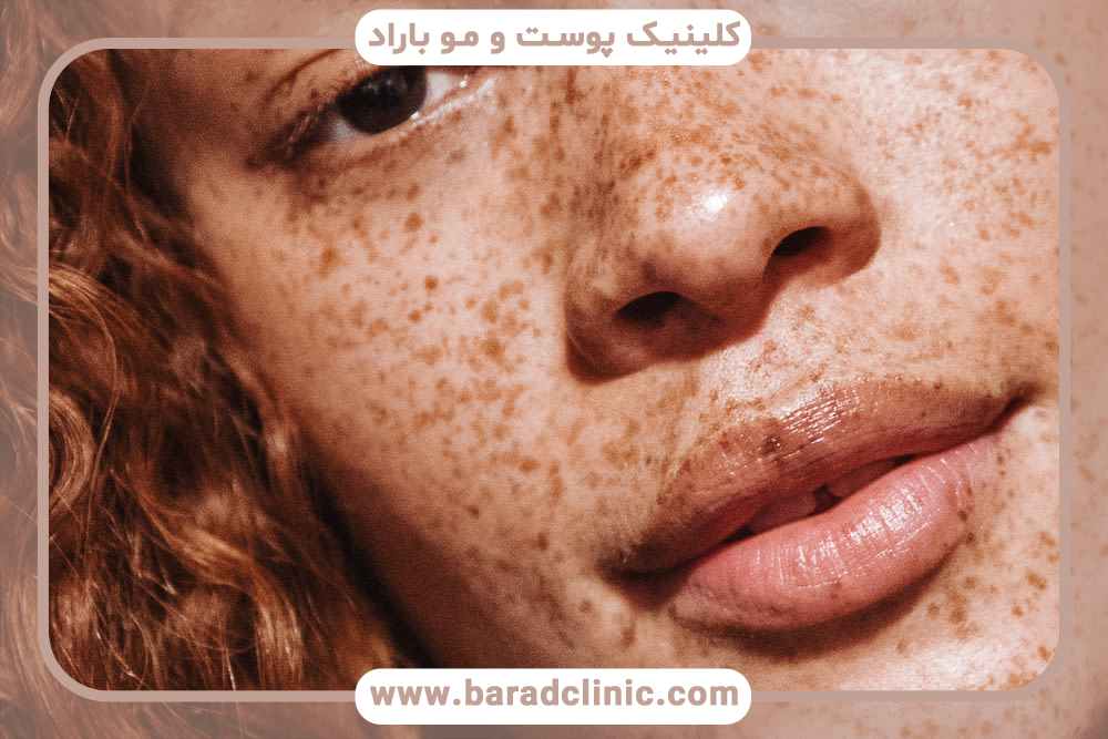 بیماری پیسی یا لک و پیس چیست و چگونه درمان می‌شود؟