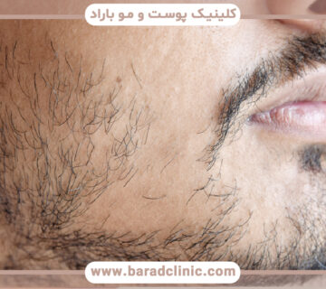 کاشت ریش و سبیل چگونه است؟