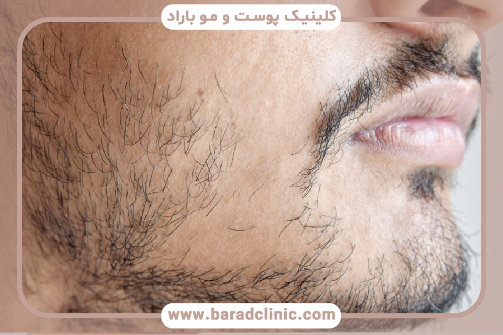 کاشت ریش و سبیل چگونه است؟