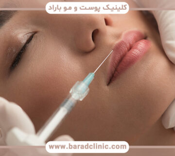 تزریق هیالورونیک اسید برای لب چگونه است