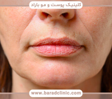راه های برطرف کردن چین و چروک اطراف لب چیست؟