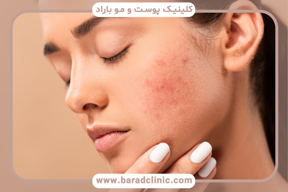 سابسیژن پوست