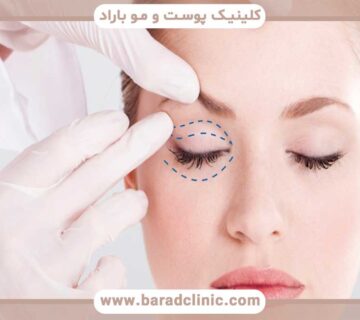 How does blepharoplasty help improve the appearance of the eyes?