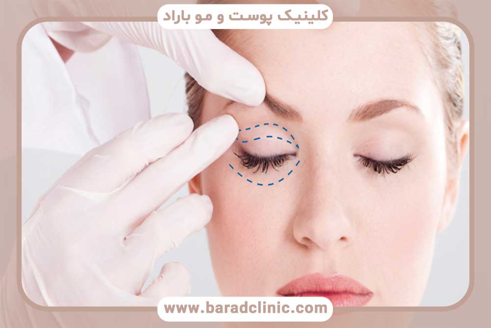 How does blepharoplasty help improve the appearance of the eyes?
