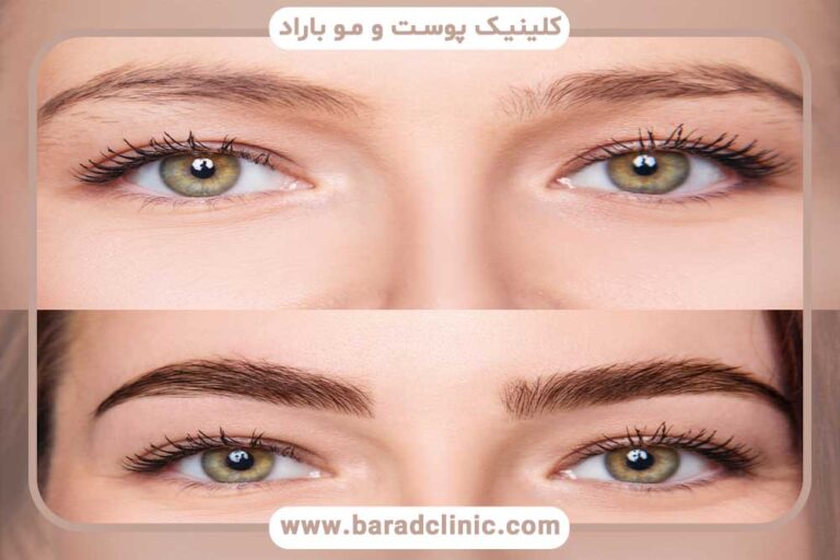 eyebrow transplant