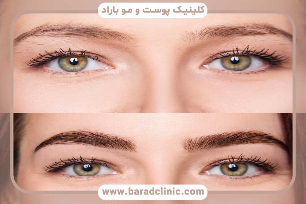 کاشت ابرو چگونه می‌تواند زیبایی شما را دو چندان کند