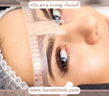 کاشت ابرو به روش FUT