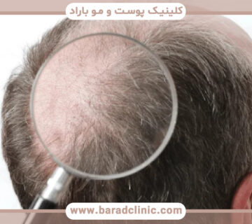 روش کاشت مو در ورتکس