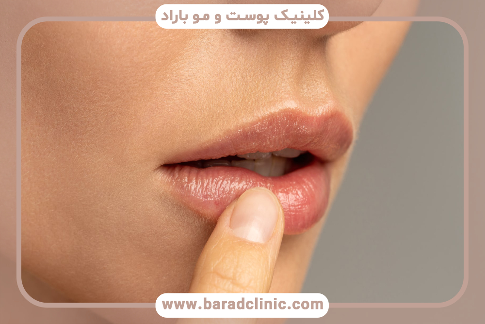  کدام روش لیفت لب برای شما مناسب است؟ بررسی تکنیک‌های لیفت لب