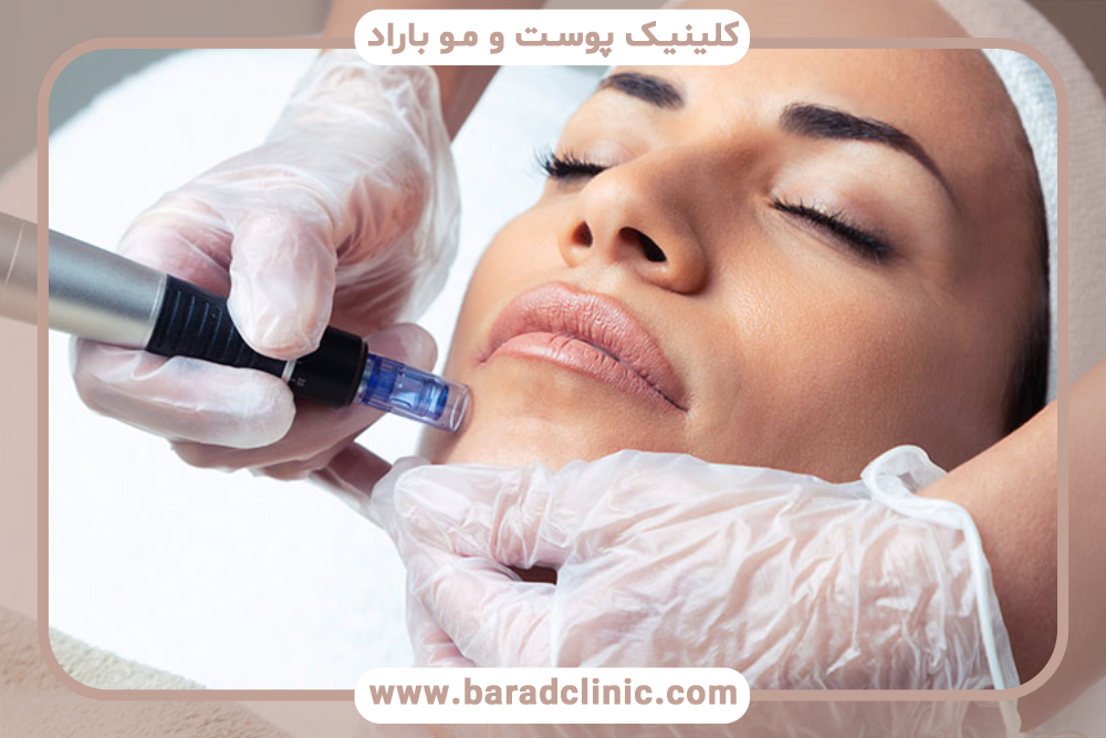 آیا از بین بردن ضایعات عروقی توسط لیزر ان دیاگ ممکن است؟