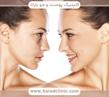 Who is cheek fat injection suitable for?