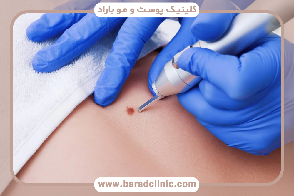 کاربرد کرایوتراپی در درمان بیماری های پوستی