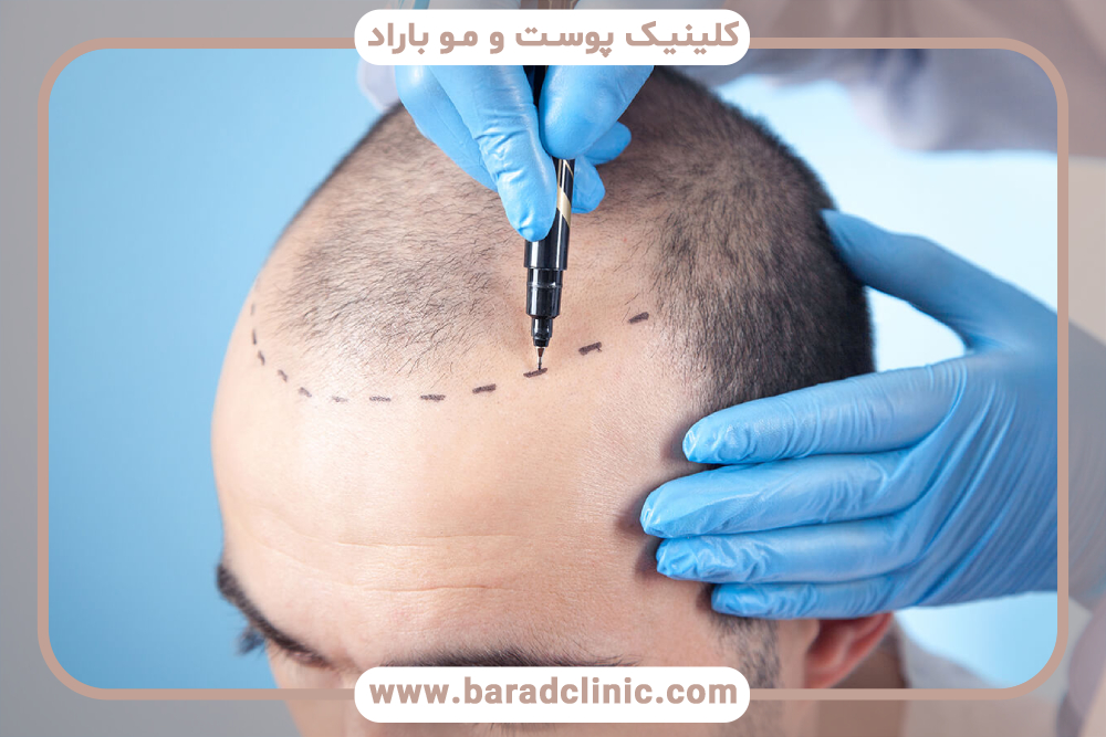 کاشت مو با برداشت از ریش