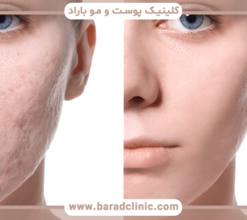 از بین بردن جای جوش