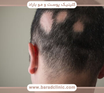 آلوپسی چیست و انواع آلوپسی کدام است؟