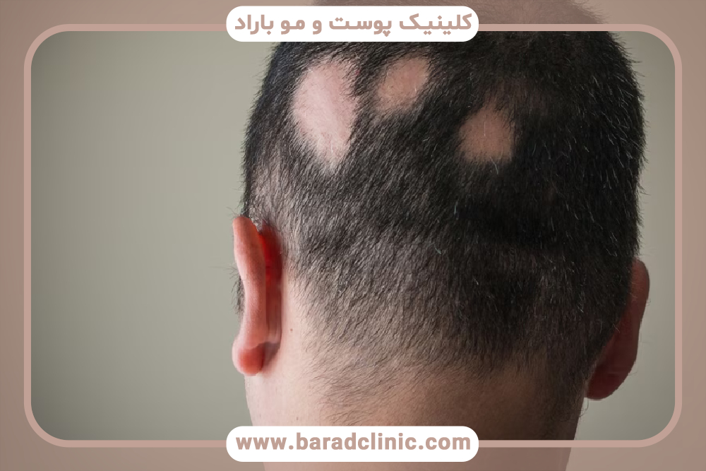 آلوپسی چیست و انواع آلوپسی کدام است؟