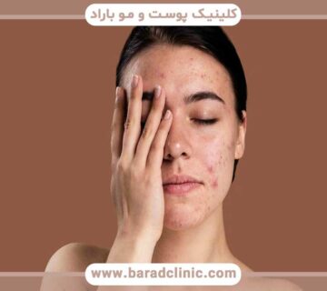 Treatment of dry and sensitive skin