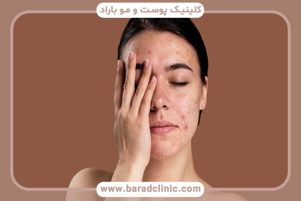 Treatment of dry and sensitive skin