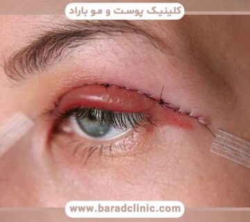 Blepharoplasty scar