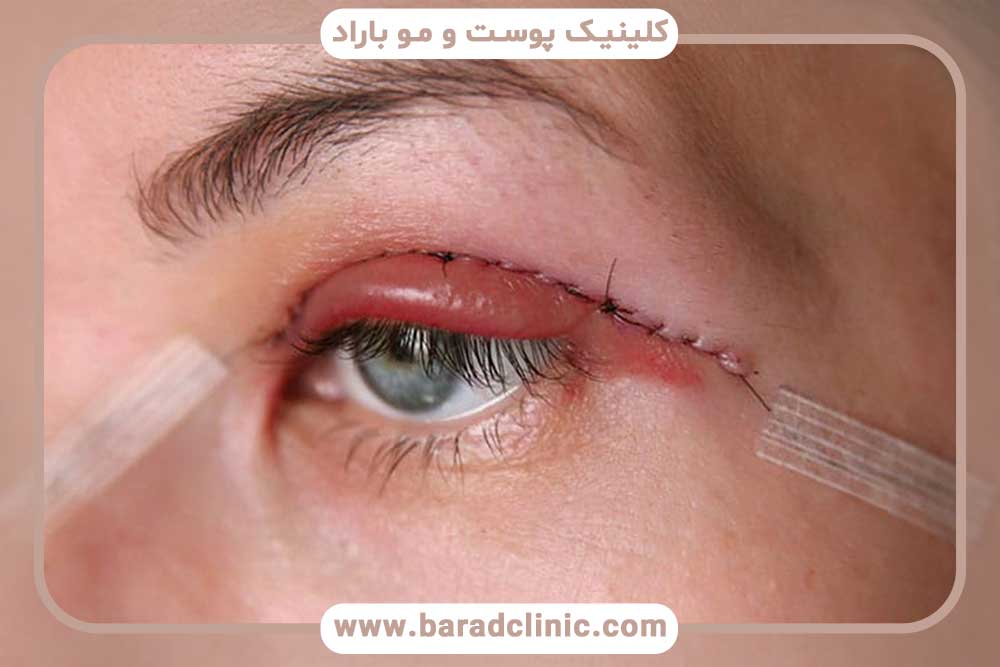 Blepharoplasty scar