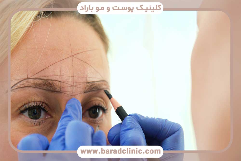 Eyebrow transplantation using the IT method