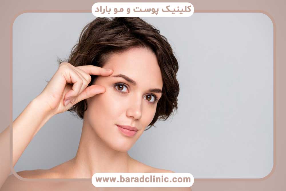 Eyebrow transplantation with short hair