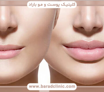 فیلر لب