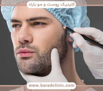 کاشت ریش و سبیل برای رفع مشکل بی مویی صورت آقایان