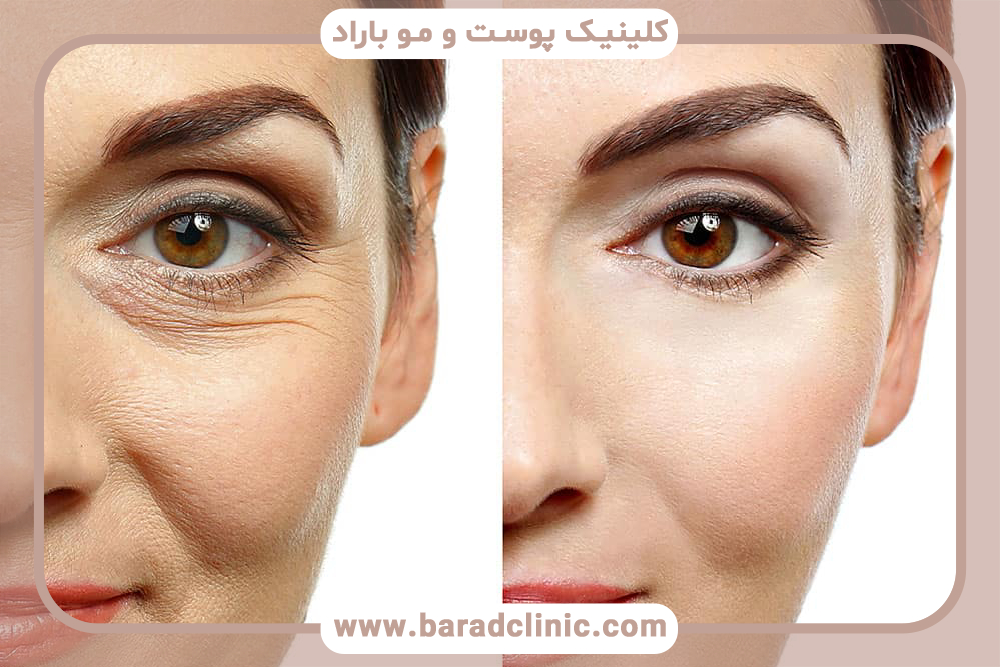 کربوکسی تراپی دور چشم چیست؟