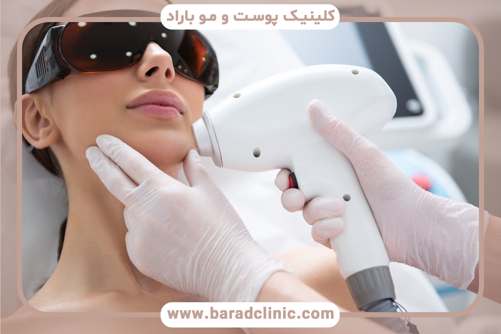 لیزر موهای زائد صورت