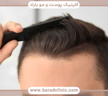 بهترین و جدیدترین روشهای کاشت مو طبیعی