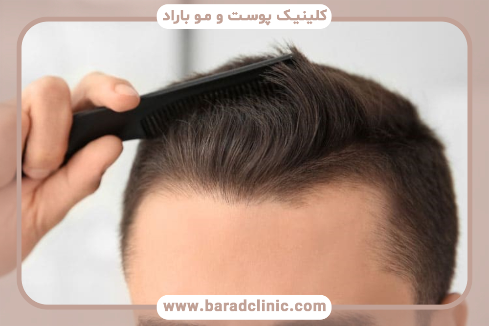 بهترین و جدیدترین روش‌های کاشت مو طبیعی