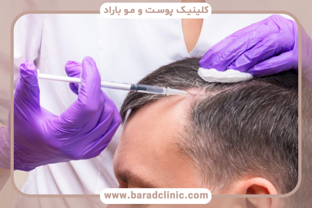 پی آر پی مو چیست و چه عوارضی ممکن است داشته باشد؟