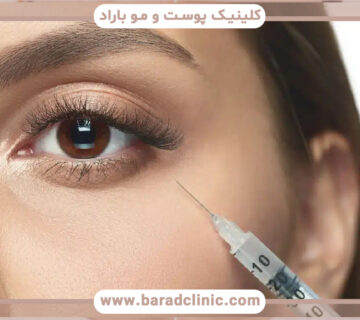 پی آر پی زیر چشم