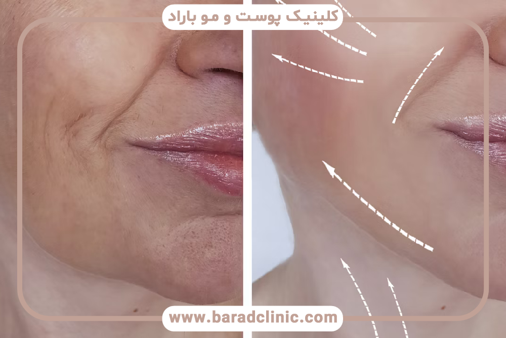 اس وی اف ژل (SVF Gel) چیست؟