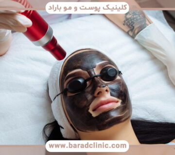 کربن پیل با لیزر چیست و چه کاربردی دارد؟