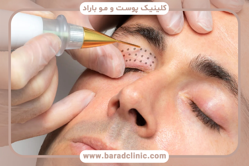 پلاسما جت پلک چیست و چه مزایایی دارد؟