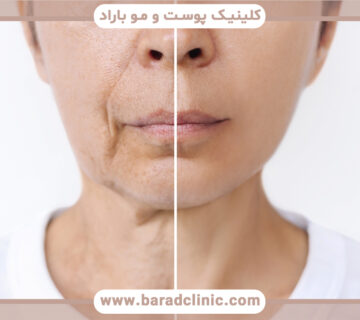معکوس کردن علائم پیری صورت و بازگشت به جوانی طبیعی
