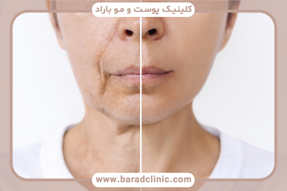 معکوس کردن علائم پیری صورت و بازگشت به جوانی طبیعی