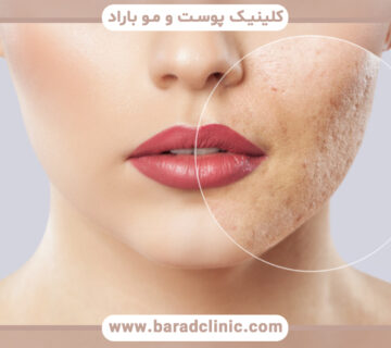 علت منافذ باز پوست صورت چیست؟